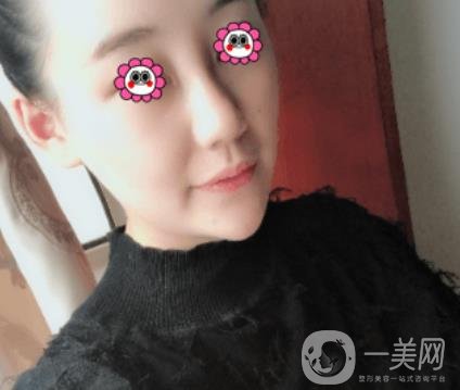 鼓樓醫(yī)院可以打*嗎?附案例恢復(fù)圖及整形價格表