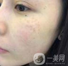 蘇州附一醫(yī)院可以激光祛斑嗎?案例圖及整形價格表分享