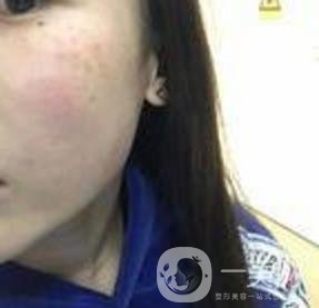 蘇州附一醫(yī)院可以激光祛斑嗎?案例圖及整形價格表分享