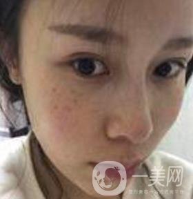 蘇州附一醫(yī)院可以激光祛斑嗎?案例圖及整形價格表分享