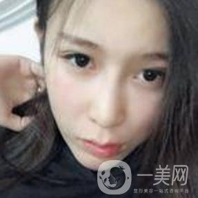 蘇州附一醫(yī)院可以激光祛斑嗎?案例圖及整形價格表分享