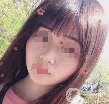 贛州附屬醫(yī)院整形美容科價格表及點痣案例公布，速覽