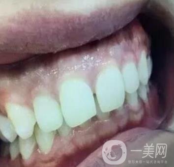 龍崗中心醫(yī)院整牙多少錢？價格表2020收費明細公開一覽