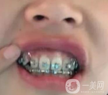 龍崗中心醫(yī)院整牙多少錢？價格表2020收費明細公開一覽