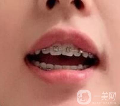 龍崗中心醫(yī)院整牙多少錢？價格表2020收費明細公開一覽