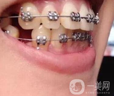 北京市海淀醫(yī)院口腔科價(jià)格表2020更新，附牙齒矯正案例