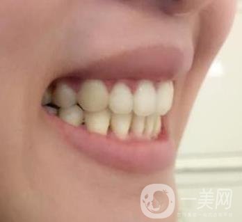 北京市海淀醫(yī)院口腔科價(jià)格表2020更新，附牙齒矯正案例