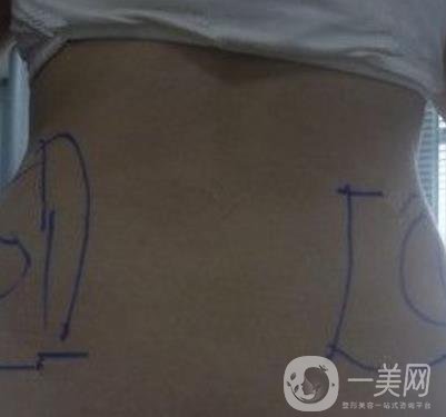 襄陽市第一人民醫(yī)院整形美容科吸脂瘦肚子多少錢？價格表整形日記一覽