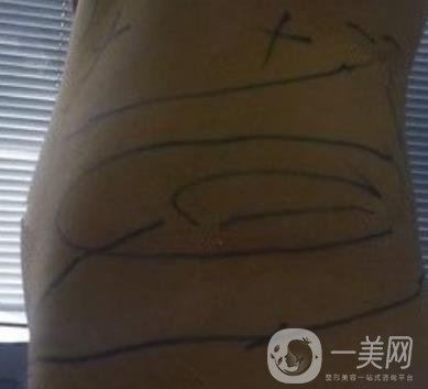 襄陽市第一人民醫(yī)院整形美容科吸脂瘦肚子多少錢？價格表整形日記一覽