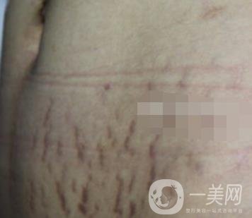 陽(yáng)煤集團(tuán)總醫(yī)院整形美容科祛妊娠紋恢復(fù)記錄，內(nèi)附價(jià)格表