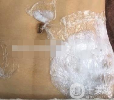 陽(yáng)煤集團(tuán)總醫(yī)院整形美容科祛妊娠紋恢復(fù)記錄，內(nèi)附價(jià)格表