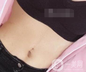 陽(yáng)煤集團(tuán)總醫(yī)院整形美容科祛妊娠紋恢復(fù)記錄，內(nèi)附價(jià)格表