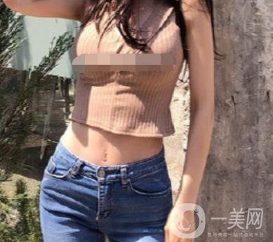 陽(yáng)煤集團(tuán)總醫(yī)院整形美容科祛妊娠紋恢復(fù)記錄，內(nèi)附價(jià)格表