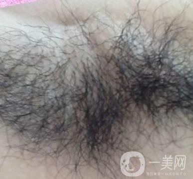 山東省立醫(yī)院整形科激光脫毛*果好嗎?價格收費標準表一覽