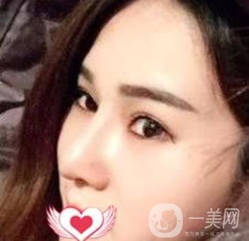 上海市第一人民醫(yī)院整形科隆鼻大概要多少錢?附價格明細(xì)一覽表