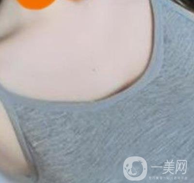 廣州南方醫(yī)院美容科怎么樣?附2020全新價(jià)格表及隆胸案例