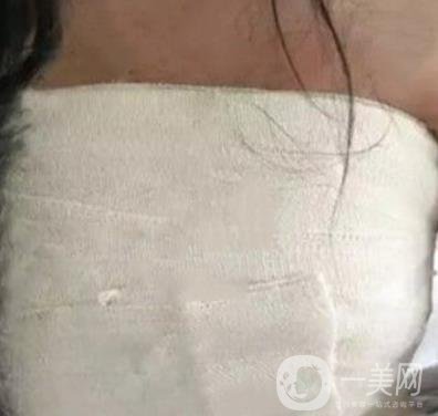 廣州南方醫(yī)院美容科怎么樣?附2020全新價(jià)格表及隆胸案例