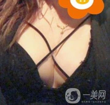 廣州南方醫(yī)院美容科怎么樣?附2020全新價(jià)格表及隆胸案例