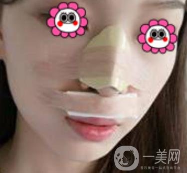 沈陽杏林崔昌墉做鼻子怎么樣?2020整形價(jià)格表一覽