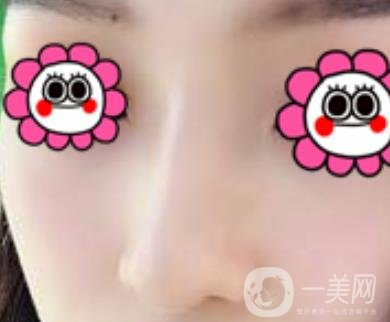 沈陽杏林崔昌墉做鼻子怎么樣?2020整形價(jià)格表一覽