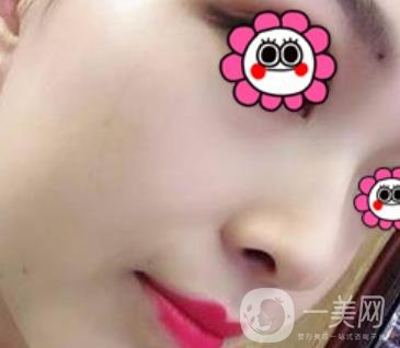 沈陽杏林崔昌墉做鼻子怎么樣?2020整形價(jià)格表一覽