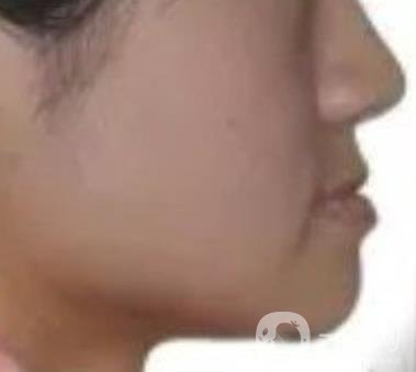 鄭大一附院口腔正畸怎么樣?附項(xiàng)目?jī)r(jià)格表及案例圖