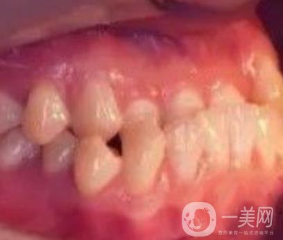 鄭大一附院口腔正畸怎么樣?附項(xiàng)目?jī)r(jià)格表及案例圖