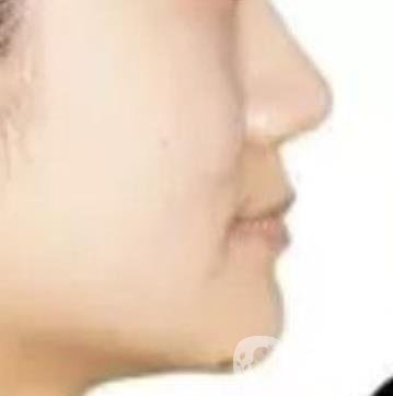 鄭大一附院口腔正畸怎么樣?附項(xiàng)目?jī)r(jià)格表及案例圖