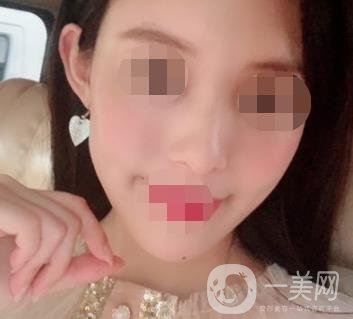 南大一附院整形美容科價格表2020版及祛疤案例