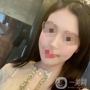 南大一附院整形美容科價格表2020版及祛疤案例