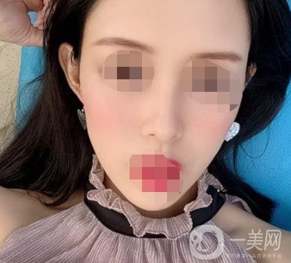 南大一附院整形美容科價格表2020版及祛疤案例