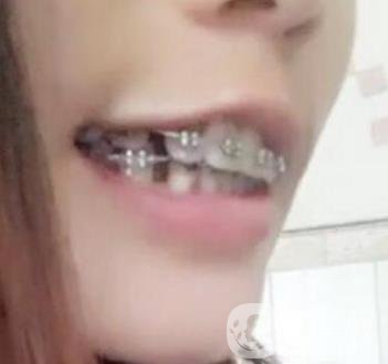 桂林美奧口腔醫(yī)院價格表全新版，附牙齒矯正案例