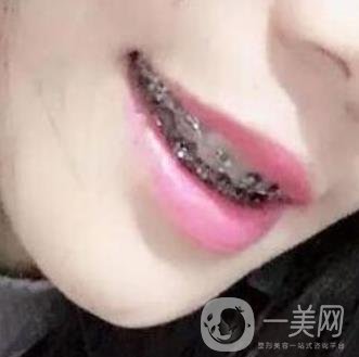 桂林美奧口腔醫(yī)院價格表全新版，附牙齒矯正案例