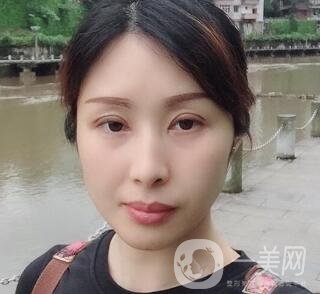 沈陽軍區(qū)總醫(yī)院整形外科價格表，附雙眼皮真實案例