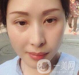 沈陽軍區(qū)總醫(yī)院整形外科價格表，附雙眼皮真實案例