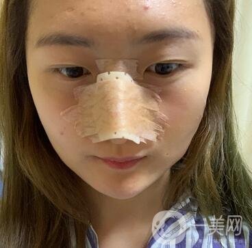 重慶新橋醫(yī)院整形科價格表，隆鼻案例分享