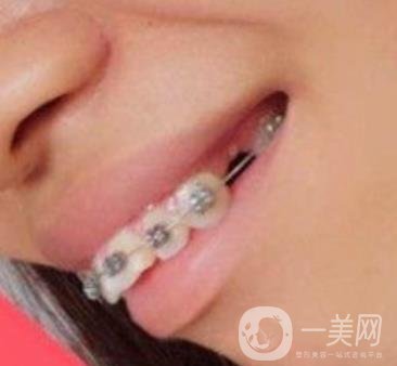 復旦大學附屬兒科醫(yī)院口腔科做牙齒矯正多少錢？價格表明細一覽