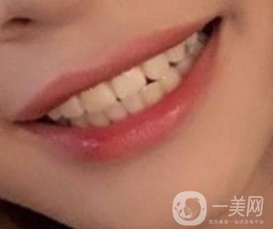 復旦大學附屬兒科醫(yī)院口腔科做牙齒矯正多少錢？價格表明細一覽