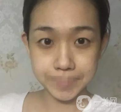 重慶醫(yī)科大學附屬第一醫(yī)院整形科價格價目表，附雙眼皮*果圖