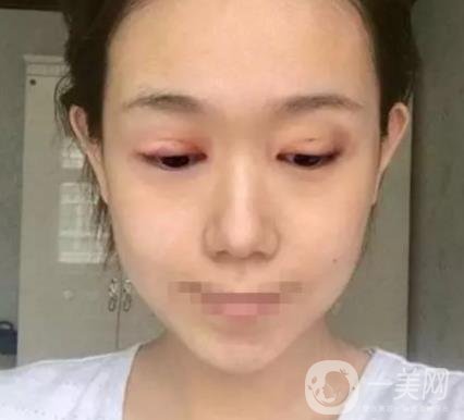 重慶醫(yī)科大學附屬第一醫(yī)院整形科價格價目表，附雙眼皮*果圖