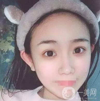 重慶醫(yī)科大學附屬第一醫(yī)院整形科價格價目表，附雙眼皮*果圖