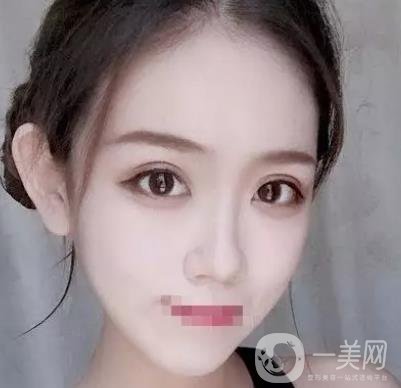 重慶醫(yī)科大學附屬第一醫(yī)院整形科價格價目表，附雙眼皮*果圖