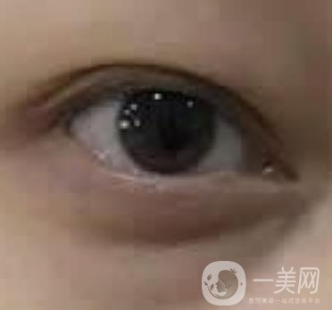 大理附屬醫(yī)院可以做去眼袋嗎?案例及整形價(jià)格表一覽