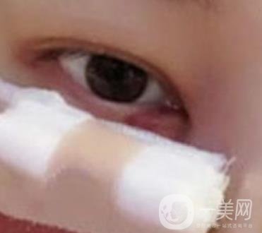 大理附屬醫(yī)院可以做去眼袋嗎?案例及整形價(jià)格表一覽