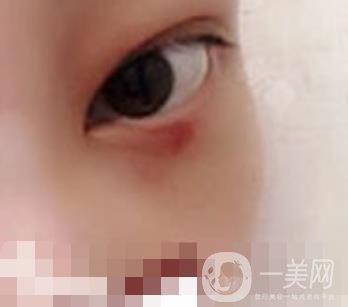 大理附屬醫(yī)院可以做去眼袋嗎?案例及整形價(jià)格表一覽