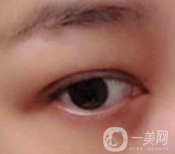 大理附屬醫(yī)院可以做去眼袋嗎?案例及整形價(jià)格表一覽