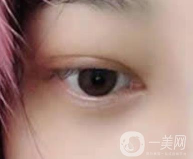 大理附屬醫(yī)院可以做去眼袋嗎?案例及整形價(jià)格表一覽