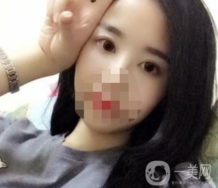 長海醫(yī)院去眼袋