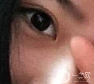 第一醫(yī)院去眼袋