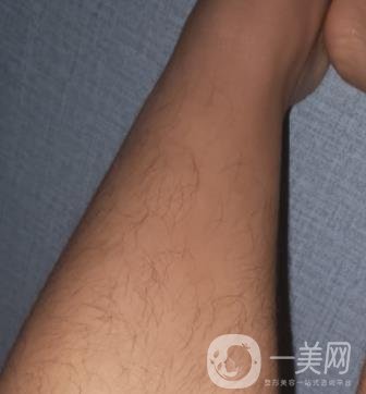 哈醫(yī)大四院整形美容科價(jià)格表鉅惠來(lái)襲，附冰點(diǎn)脫毛案例